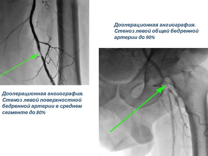 Дооперационная ангиография. Стеноз левой поверхностной бедренной артерии в среднем сегменте до 80%