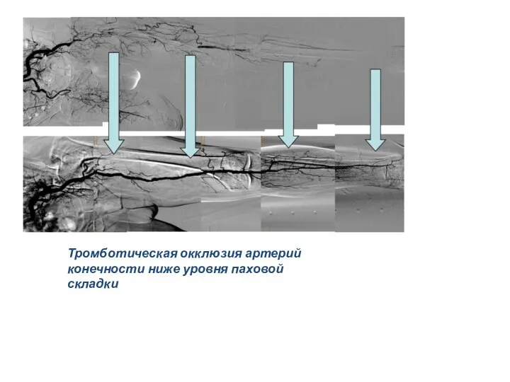 Тромботическая окклюзия артерий конечности ниже уровня паховой складки