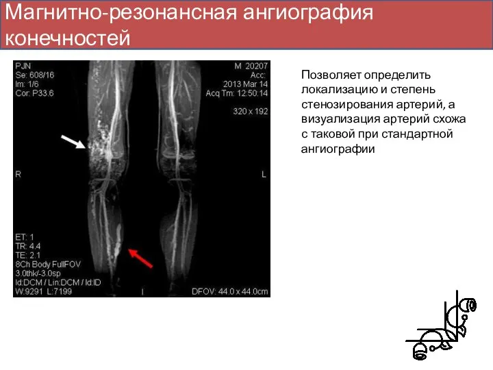 Магнитно-резонансная ангиография конечностей Позволяет определить локализацию и степень стенозирования артерий, а визуализация