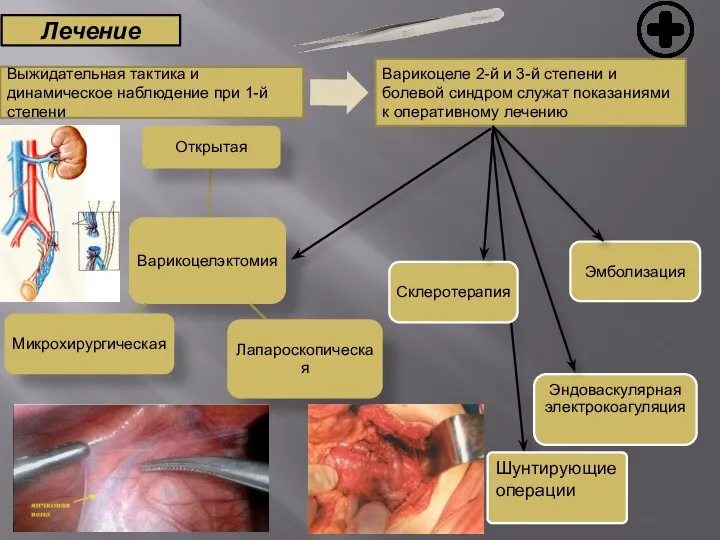 Лечение Выжидательная тактика и динамическое наблюдение при 1-й степени Варикоцеле 2-й и