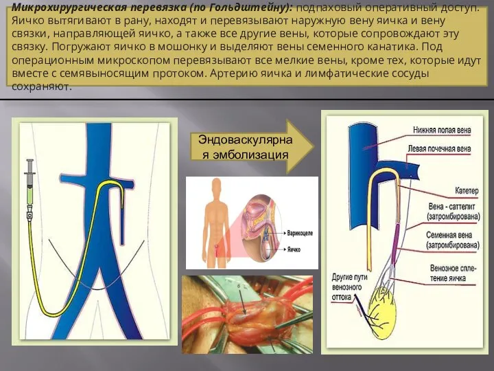 Эндоваскулярная эмболизация Микрохирургическая перевязка (по Гольдштейну): подпаховый оперативный доступ. Яичко вытягивают в