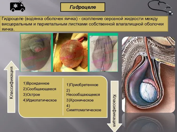 Гидроцеле Гидроцеле (водянка оболочек яичка) - скопление серозной жидкости между висцеральным и