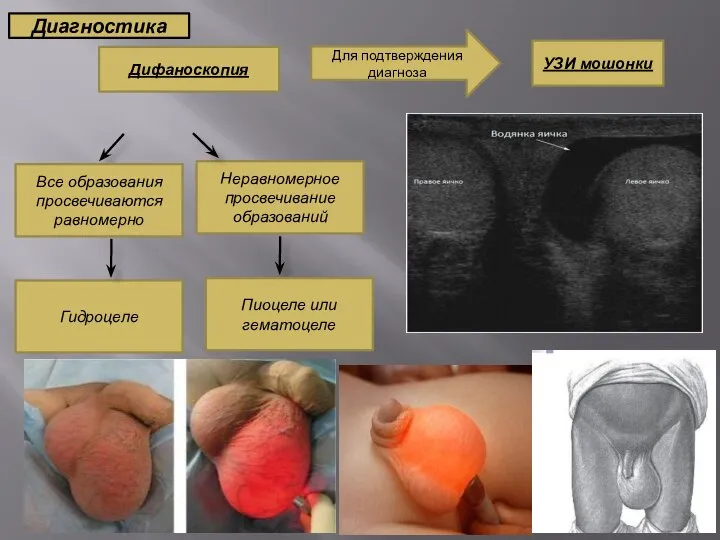 Диагностика Дифаноскопия УЗИ мошонки Для подтверждения диагноза Все образования просвечиваются равномерно Неравномерное