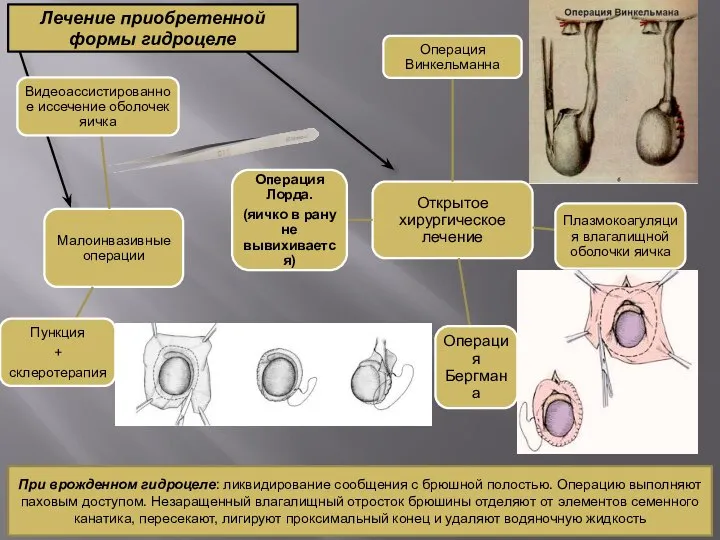 Лечение приобретенной формы гидроцеле При врожденном гидроцеле: ликвидирование сообщения с брюшной полостью.