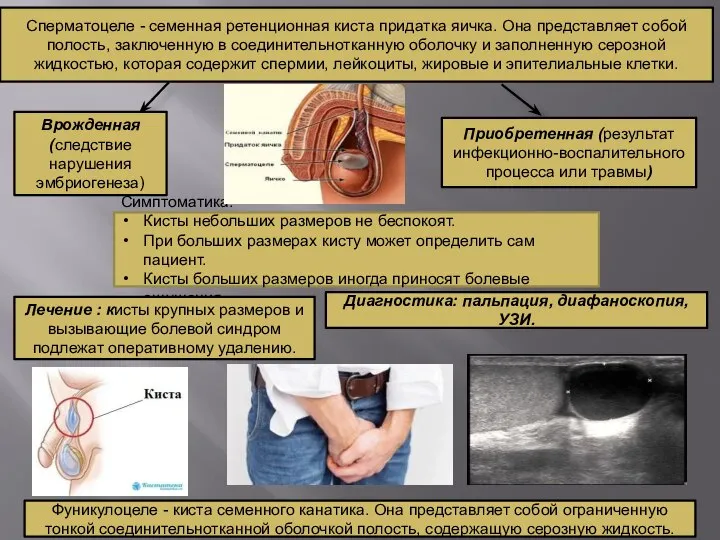 Сперматоцеле - семенная ретенционная киста придатка яичка. Она представляет собой полость, заключенную