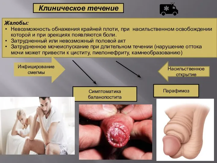 Жалобы: Невозможность обнажения крайней плоти, при насильственном освобождении которой и при эрекциях