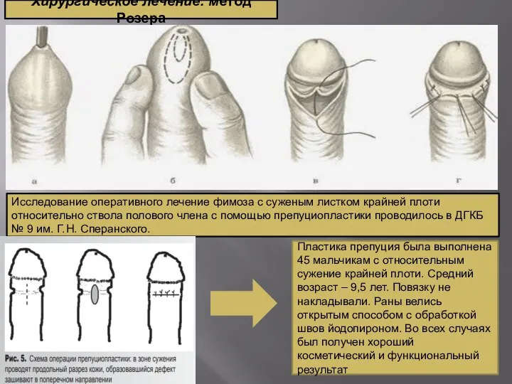 Хирургическое лечение: метод Розера Исследование оперативного лечение фимоза с суженым листком крайней