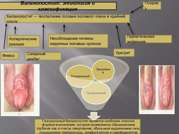 Баланопостит: этиология и классификация Баланопостит — воспаление головки полового члена и крайней