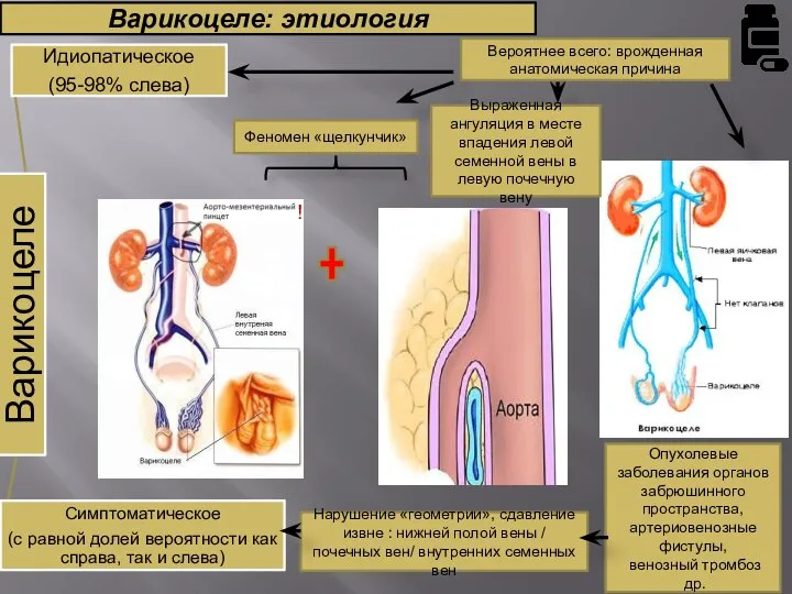 Варикоцеле: этиология Опухолевые заболевания органов забрюшинного пространства, артериовенозные фистулы, венозный тромбоз др.