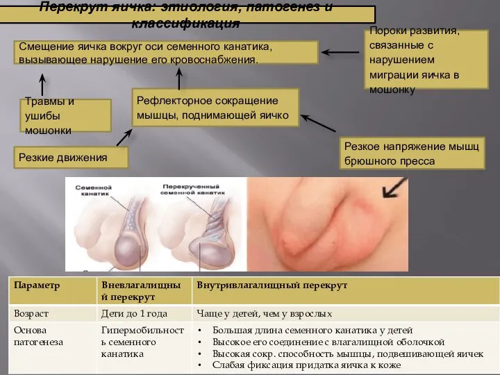 Перекрут яичка: этиология, патогенез и классификация Смещение яичка вокруг оси семенного канатика,