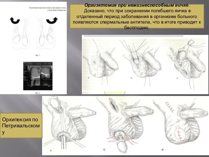 Орхипексия по Петривальскому Орхиэктомия при нежизнеспособным яичке. Доказано, что при сохранении погибшего