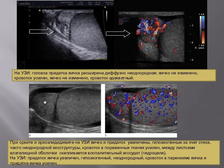 На УЗИ: головка придатка яичка расширена диффузно неоднородная; яичко не изменено, кровоток
