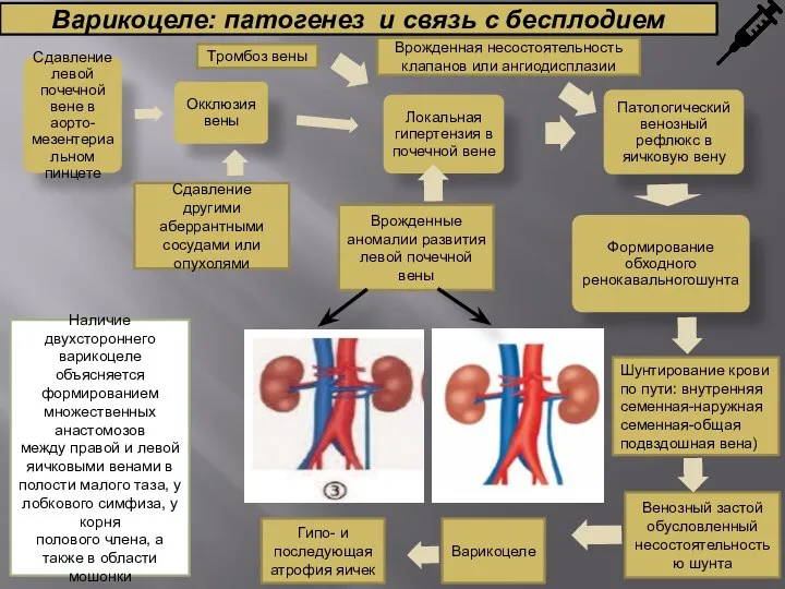 Варикоцеле: патогенез и связь с бесплодием Сдавление другими аберрантными сосудами или опухолями