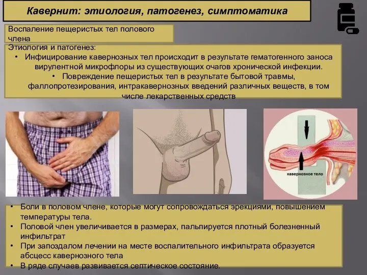 Кавернит: этиология, патогенез, симптоматика Воспаление пещеристых тел полового члена Этиология и патогенез: