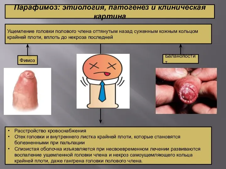 Парафимоз: этиология, патогенез и клиническая картина Ущемление головки полового члена оттянутым назад