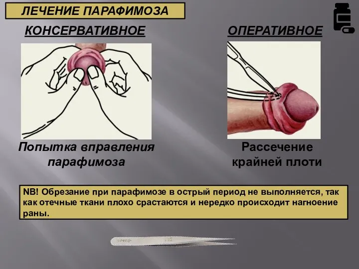 КОНСЕРВАТИВНОЕ ОПЕРАТИВНОЕ Попытка вправления парафимоза Рассечение крайней плоти ЛЕЧЕНИЕ ПАРАФИМОЗА NB! Обрезание