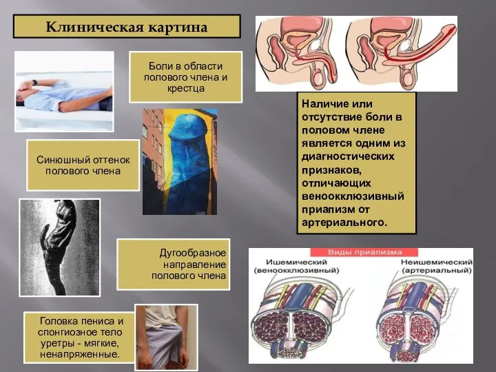Клиническая картина Наличие или отсутствие боли в половом члене является одним из