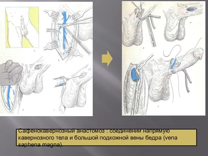 Сафенокавернозный анастомоз : соединении напрямую кавернозного тела и большой подкожной вены бедра (vena saphena magna).
