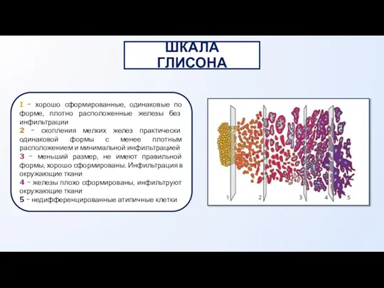 ШКАЛА ГЛИСОНА 1 − хорошо сформированные, одинаковые по форме, плотно расположенные железы