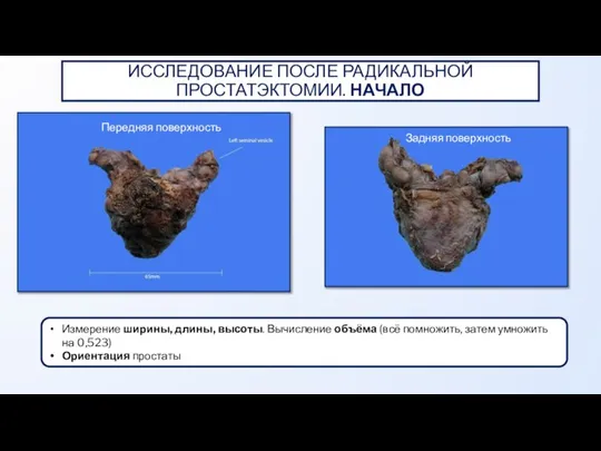 ИССЛЕДОВАНИЕ ПОСЛЕ РАДИКАЛЬНОЙ ПРОСТАТЭКТОМИИ. НАЧАЛО Измерение ширины, длины, высоты. Вычисление объёма (всё