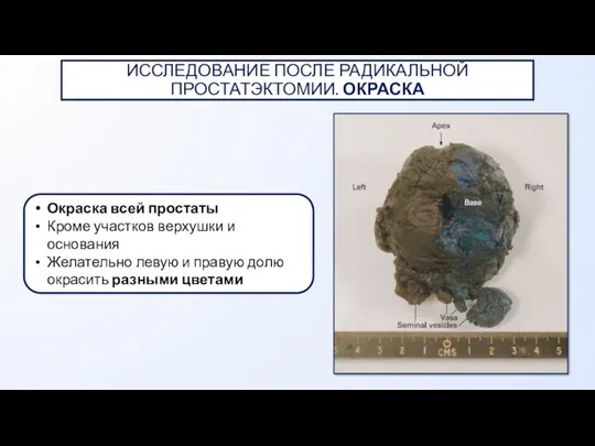 Окраска всей простаты Кроме участков верхушки и основания Желательно левую и правую