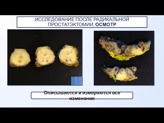 Описываются и измеряются все изменения ИССЛЕДОВАНИЕ ПОСЛЕ РАДИКАЛЬНОЙ ПРОСТАТЭКТОМИИ. ОСМОТР