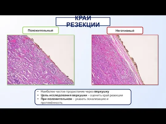 КРАЙ РЕЗЕКЦИИ Положительный Негативный Наиболее частое прорастание через верхушку Цель исследования верхушки