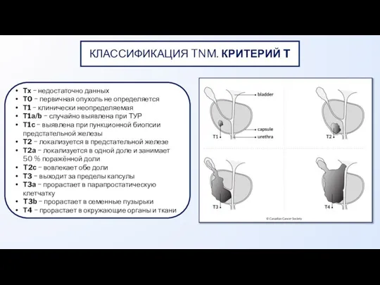 КЛАССИФИКАЦИЯ TNM. КРИТЕРИЙ T Тх − недостаточно данных Т0 − первичная опухоль