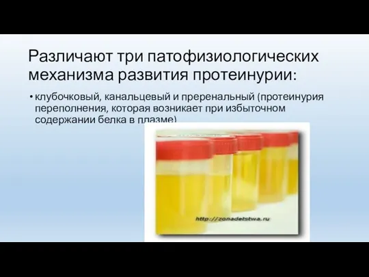 Различают три патофизиологических механизма развития протеинурии: клубочковый, канальцевый и преренальный (протеинурия переполнения,