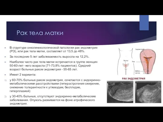 Рак тела матки В структуре онкогинекологической патологии рак эндометрия (РЭ), или рак