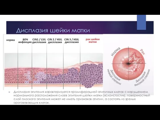 Дисплазия шейки матки Дисплазия эпителия характеризуется пролиферацией атипичных клеток с нарушением нормального
