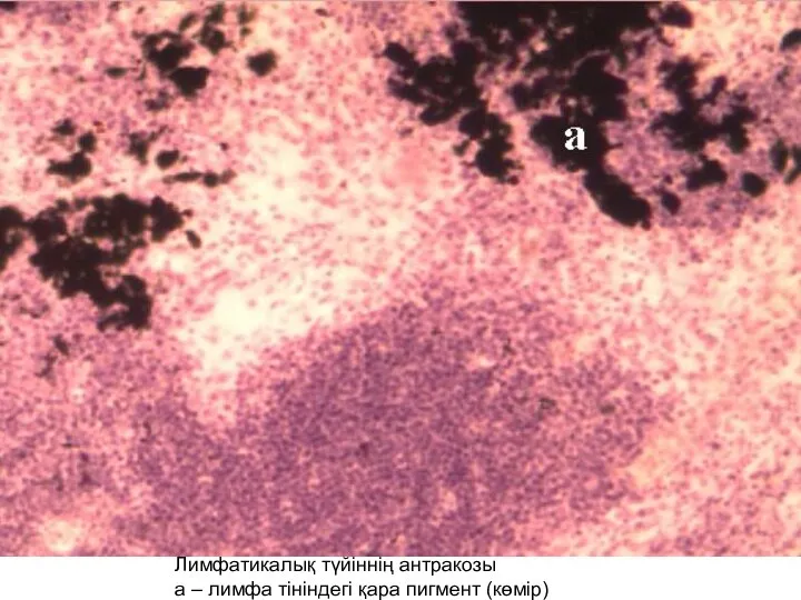 Лимфатикалық түйіннің антракозы а – лимфа тініндегі қара пигмент (көмір)