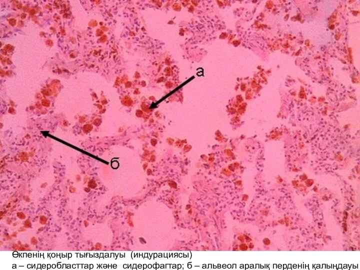 Өкпенің қоңыр тығыздалуы (индурациясы) а – сидеробласттар және сидерофагтар; б – альвеол аралық перденің қалыңдауы