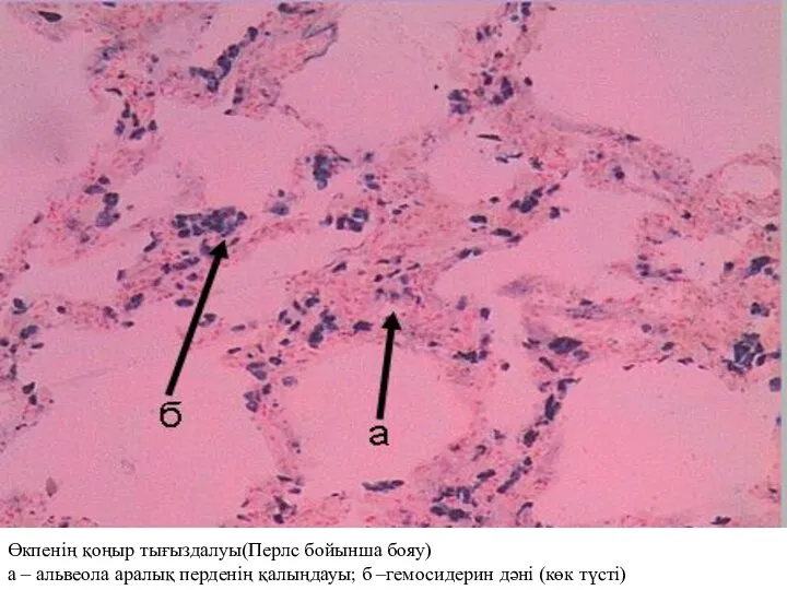 Өкпенің қоңыр тығыздалуы(Перлс бойынша бояу) а – альвеола аралық перденің қалыңдауы; б –гемосидерин дәні (көк түсті)