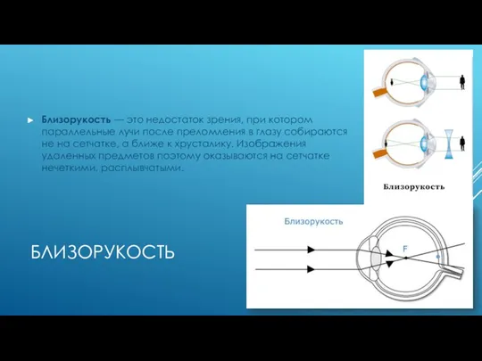 БЛИЗОРУКОСТЬ Близорукость — это недостаток зрения, при котором параллельные лучи после преломления