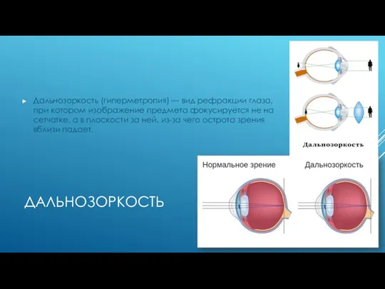 ДАЛЬНОЗОРКОСТЬ Дальнозоркость (гиперметропия) — вид рефракции глаза, при котором изображение предмета фокусируется