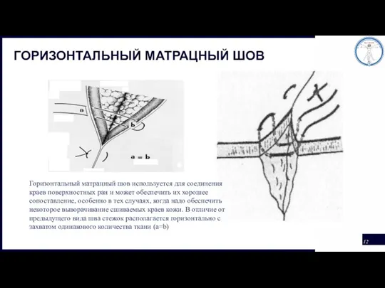 ГОРИЗОНТАЛЬНЫЙ МАТРАЦНЫЙ ШОВ Горизонтальный матрацный шов используется для соединения краев поверхностных ран