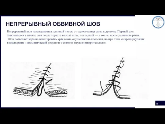 НЕПРЕРЫВНЫЙ ОБВИВНОЙ ШОВ Непрерывный шов накладывается длинной нитью от одного конца раны