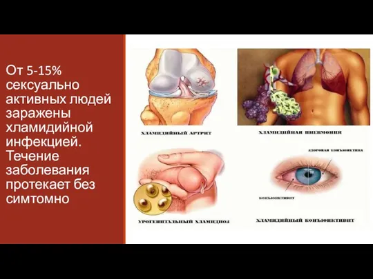 От 5-15% сексуально активных людей заражены хламидийной инфекцией. Течение заболевания протекает без симтомно