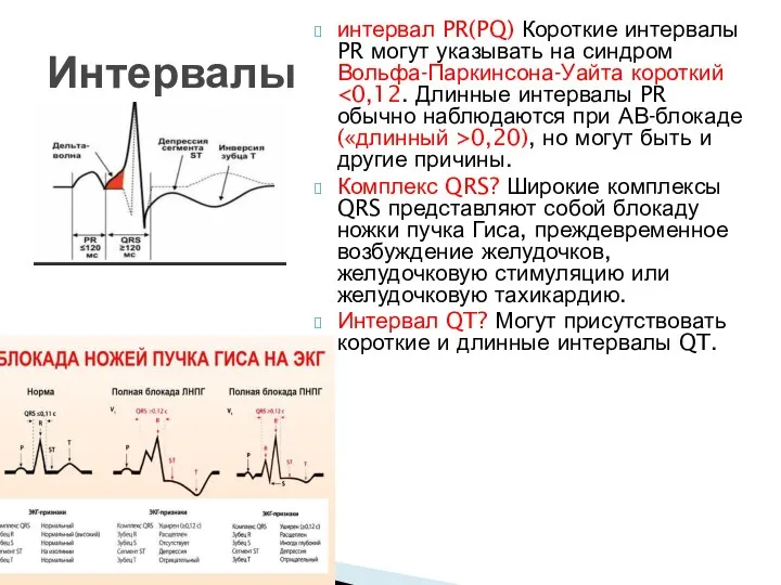 интервал PR(PQ) Короткие интервалы PR могут указывать на синдром Вольфа-Паркинсона-Уайта короткий 0,20),