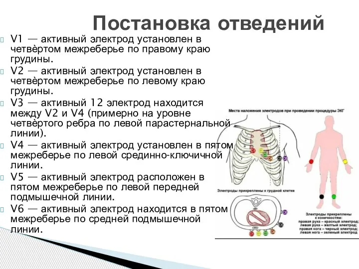 V1 — активный электрод установлен в четвѐртом межреберье по правому краю грудины.