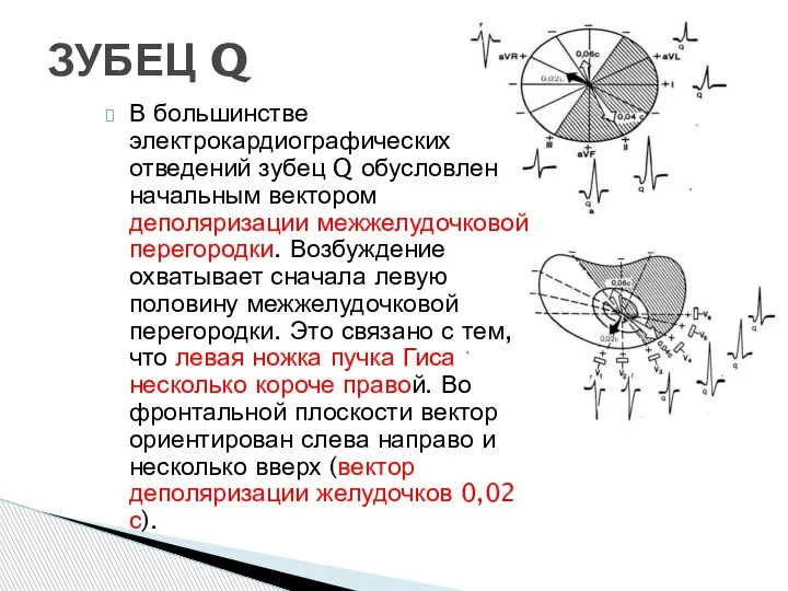 В большинстве электрокардиографических отведений зубец Q обусловлен начальным вектором деполяризации межжелудочковой перегородки.