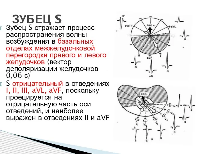 Зубец S отражает процесс распространения волны возбуждения в базальных отделах межжелудочковой перегородки