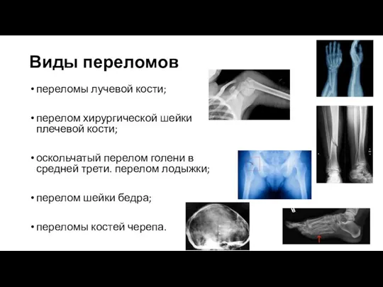 Виды переломов переломы лучевой кости; перелом хирургической шейки плечевой кости; оскольчатый перелом