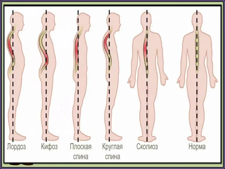 Почему происходит искривление позвоночника?
