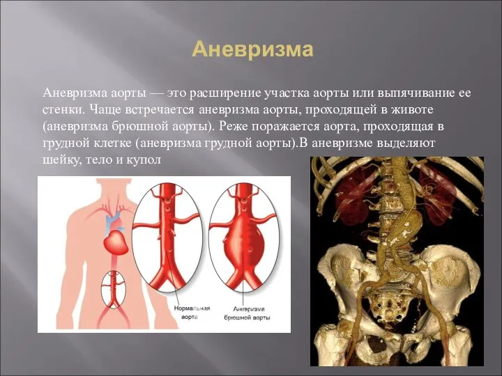 Аневризма Аневризма аорты — это расширение участка аорты или выпячивание ее стенки.