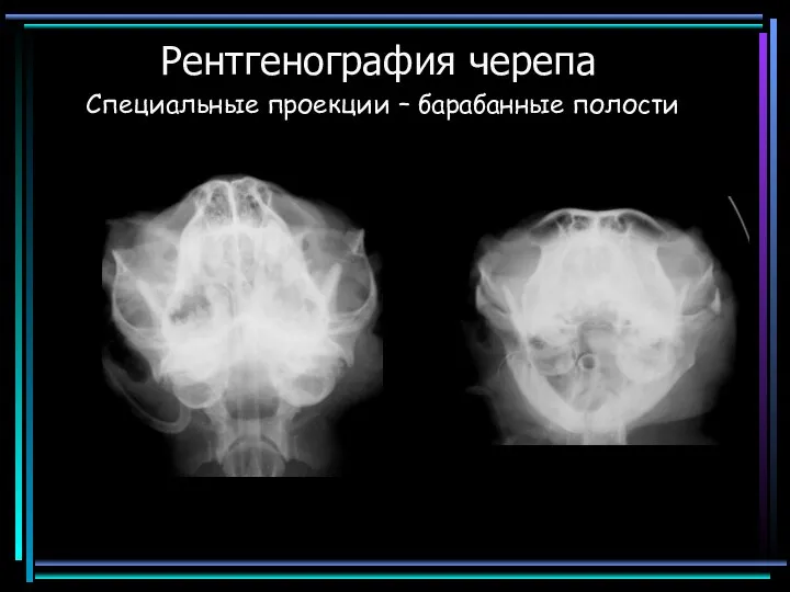 Рентгенография черепа Специальные проекции – барабанные полости