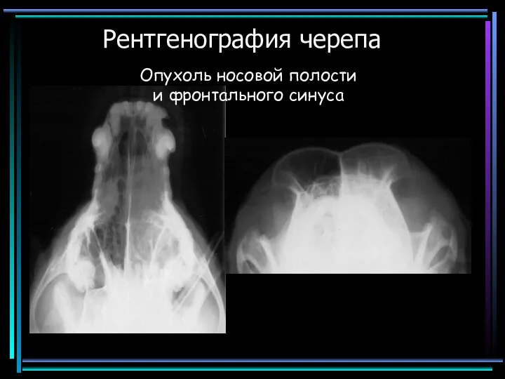 Рентгенография черепа Опухоль носовой полости и фронтального синуса