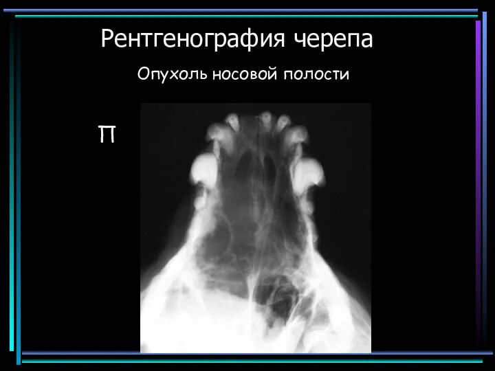 Рентгенография черепа Опухоль носовой полости П