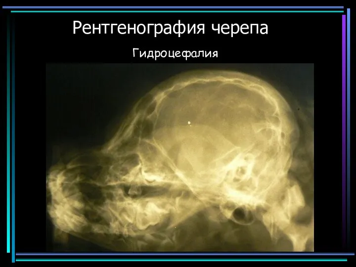 Рентгенография черепа Гидроцефалия